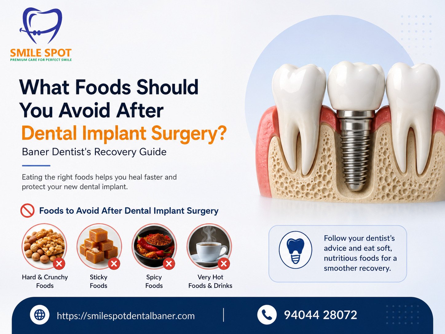 What Foods Should You Avoid After Dental Implant Surgery? Baner Dentist’s Recovery Guide