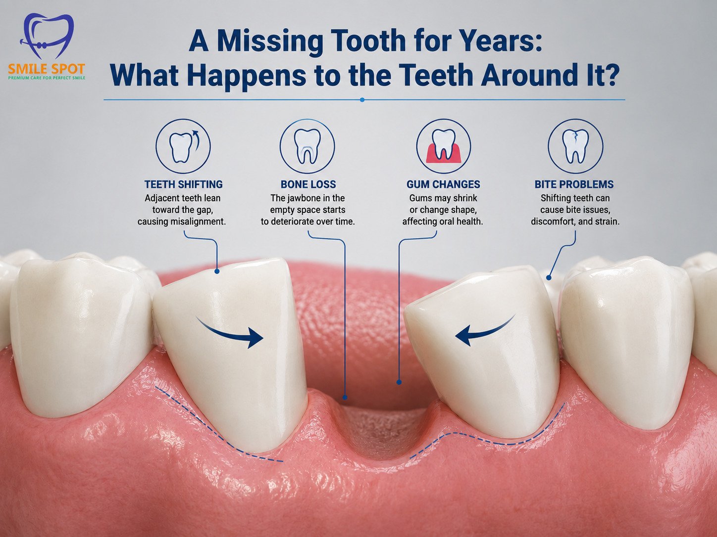 A Missing Tooth for Years: Effects on Surrounding Teeth